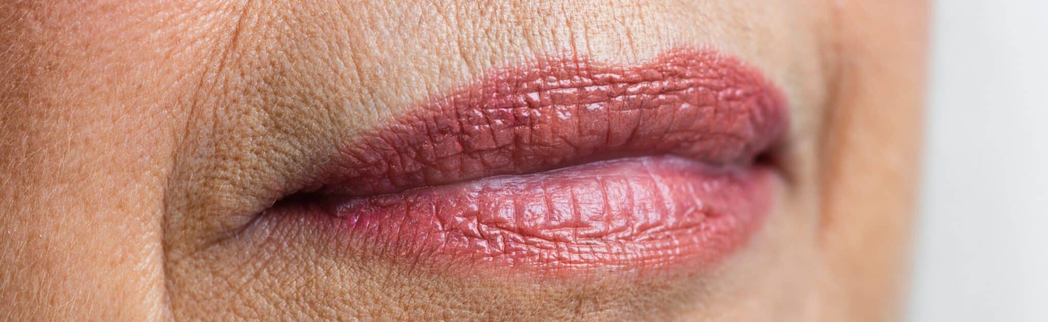 Les injections d’acide hyaluronique pour les rides péribuccales | Clinique beauté | Montpellier