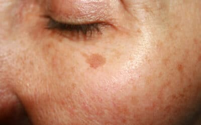 Kératose actinique | HIND Clinique de Beauté | Montpellier