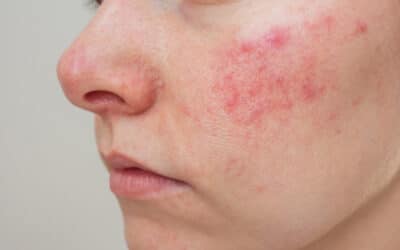 Traitement couperose et rosacée | HIND Clinique de Beauté | Montpellier