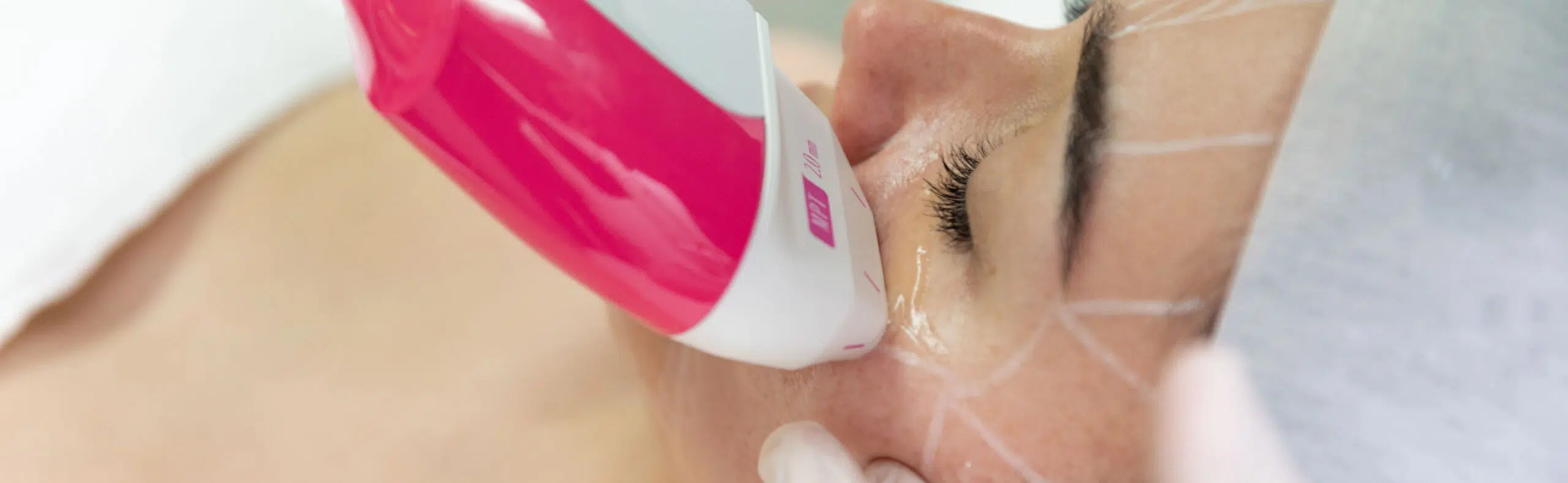 traitement du relâchement cutané par Ultrasons, comment s’y retrouver | HIND Clinique de Beauté | Montpellier